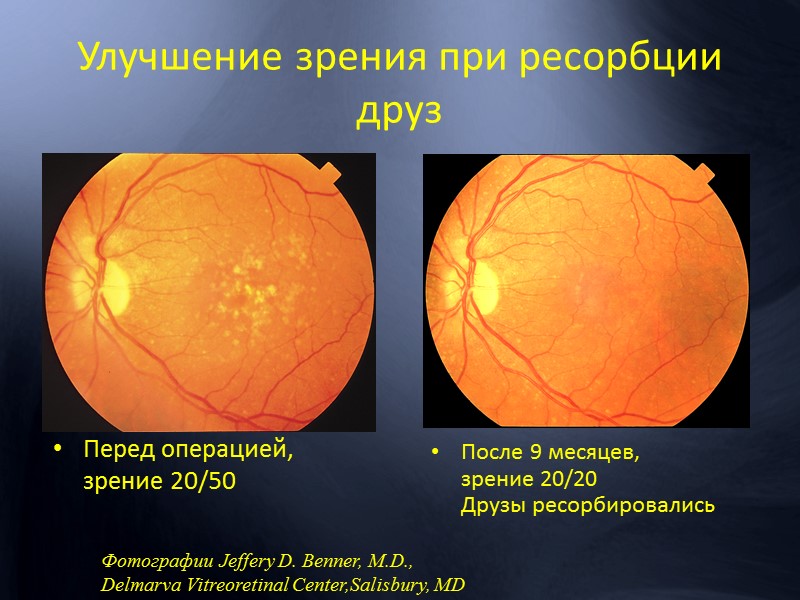 Продолжает оставаться ведущей потерей зрения пациентов с ДР.  Причина – микроокклюзии капилляров перифовеальной