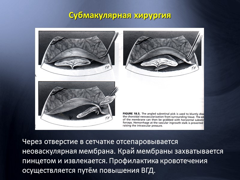 Микроаневризмы с кровоизлияниями в области верхневисочных сосудов с отеком