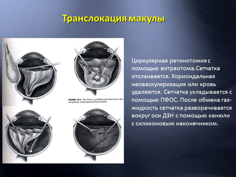 Поздняя фаза флюоресцентной ангиографии показывает  профузный “leakage” красителя из парамакулярных патологических участков