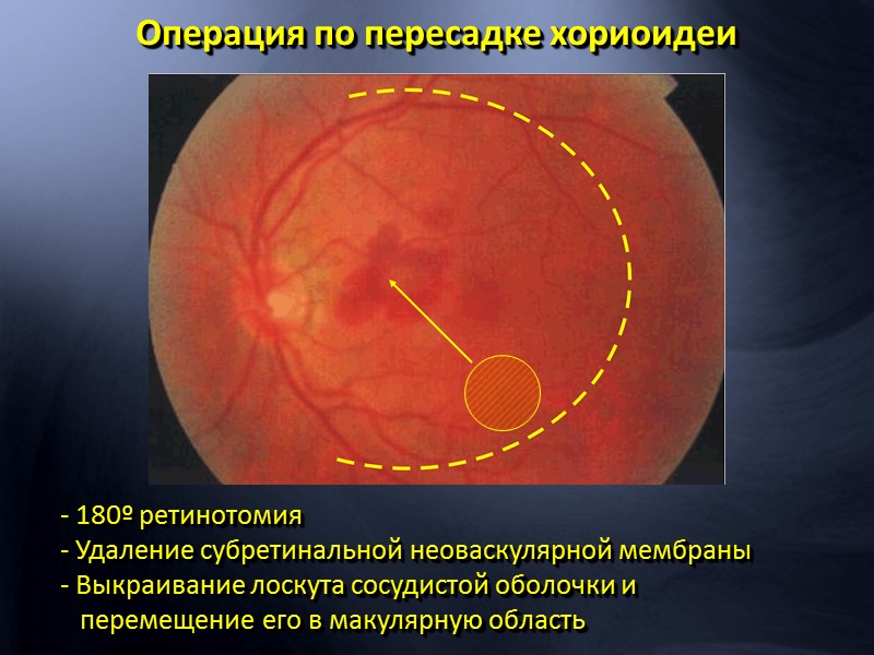 Определяется диффузный отек  сетчатки в макулярной области
