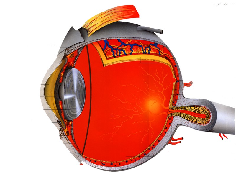 Поздняя венозная стадия флюоресцентной ангиографии показывает  “leakage” красителя из  микроаневризм  парафовеолярной