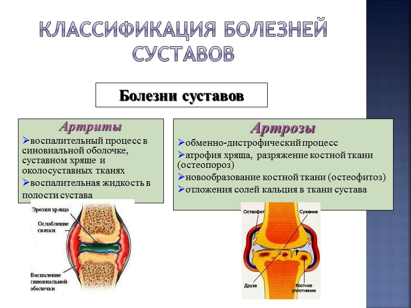 Наиболее яркая картина синовита с частыми обострениями наблюдается при остеоартрозе