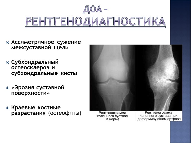 Деформирующий остеоартроз (ДОА)  ДОА- дегенеративное заболевание  суставов с элементами воспаления изменением хрящевой