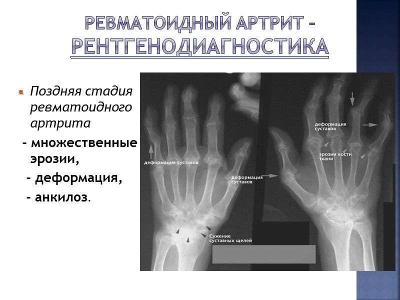 Ревматоидный артрит – суставные симптомы Типичные деформации мелких суставов кистей рук и стоп 