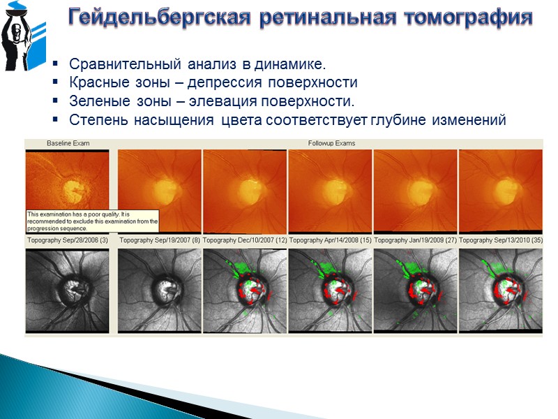 Гиперфлюоресценция Флюоресцентная ангиография А. Дефект пигментного эпителия – перестаёт экранировать хориоидальную флюоресценцию Б. Экстравазальный