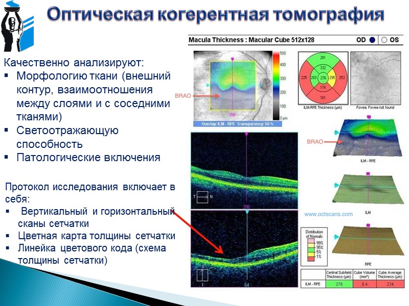 Гейдельбергская ретинальная томография (сканирующая лазерная офтальмоскопия) Цель: Визуализация элементов оптической нейропатии, наблюдаемых при глаукоме,