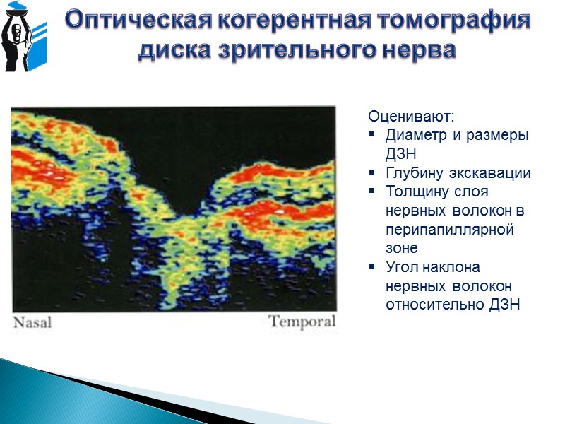 Гейдельбергская ретинальная томография Лазерный луч фокусируется на сетчатке  Детектор «улавливает» только лучи, отражённые