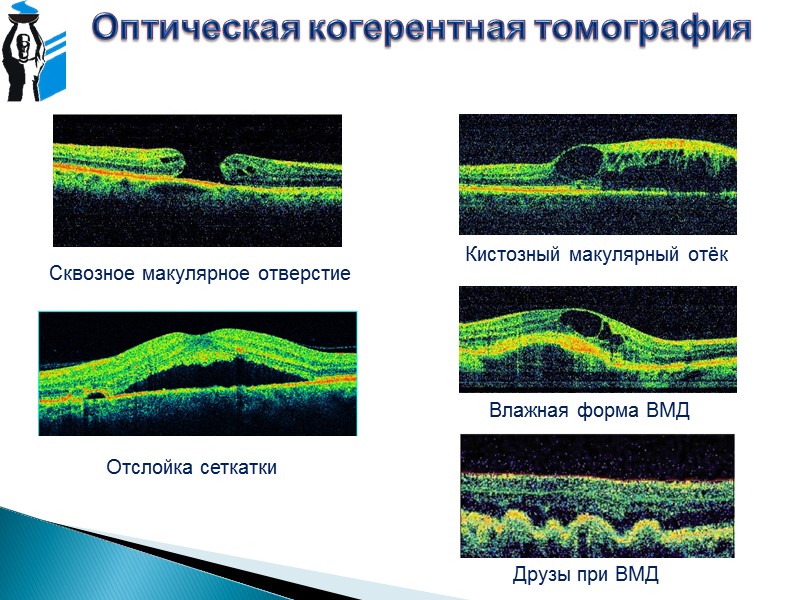 Оптическая томография