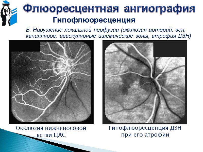 Флюоресцентная ангиография Синий возбуждающий фильтр Жёлто-зелёный барьерный фильтр Метод разработан в начале 1960-х: A.L.