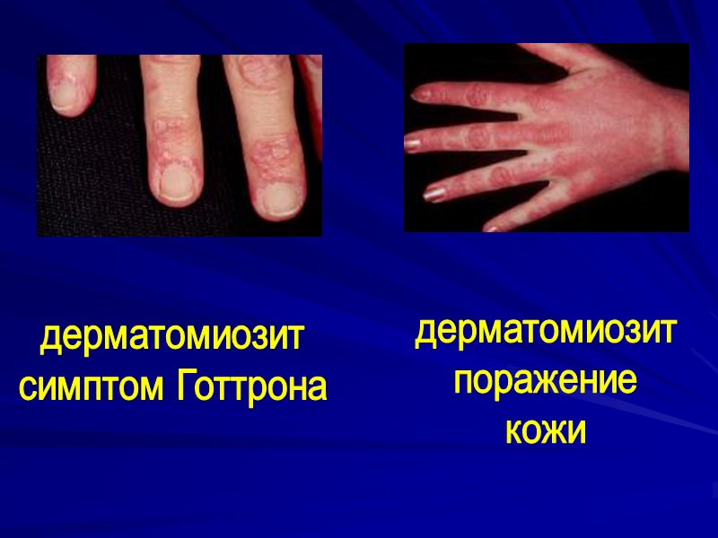 дерматомиозит симптом Готтрона дерматомиозит поражение кожи