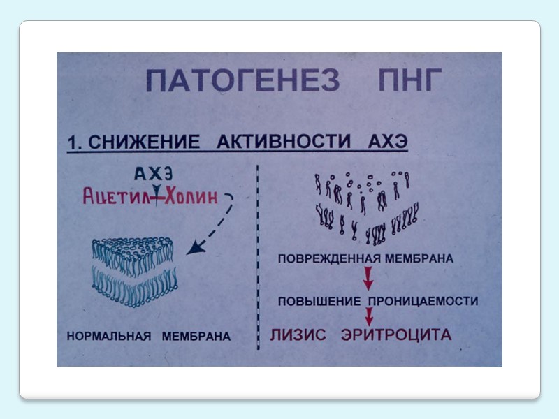 Анемия, желтуха и увеличение прямого билирубина  Печеночно-клеточная -макроцитоз, гиперхромная В моче: уробилин +