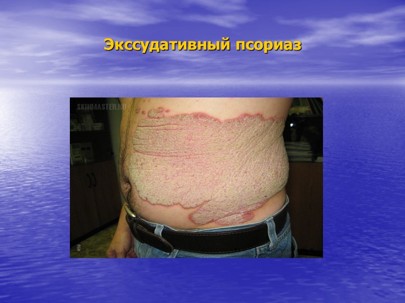 Генодерматозы-наследственные заболевания кожи, насчитывающие несколько сотен нозологических форм, проявляющихся различными патологическими процессами в коже-нарушениями