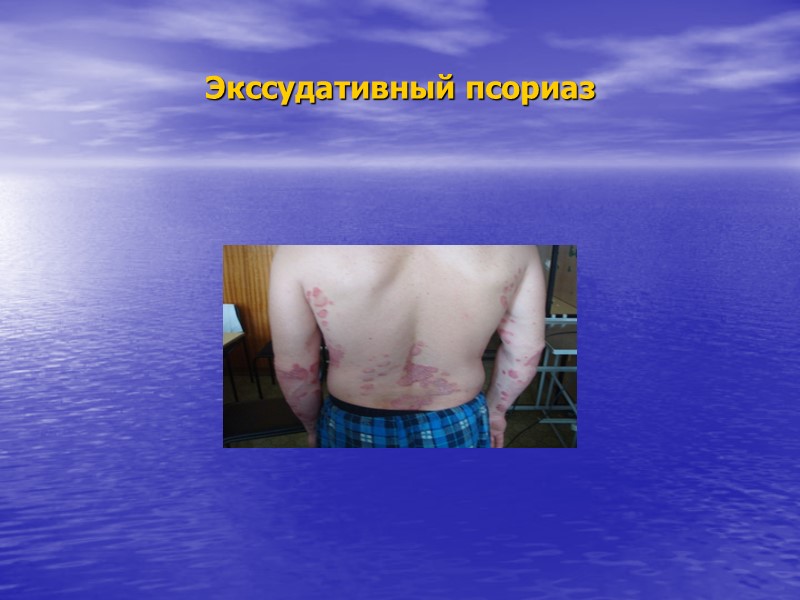 Классификация (аутосомно-доминантный тип) Псориаз Поздняя кожная порфирия Вульгарный ихтиоз Нейрофиброматоз Простой буллёзный эпидермолиз Атопический