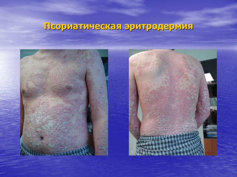 Псориаз – это хроническое системное заболевание, с преимущественным поражением кожи