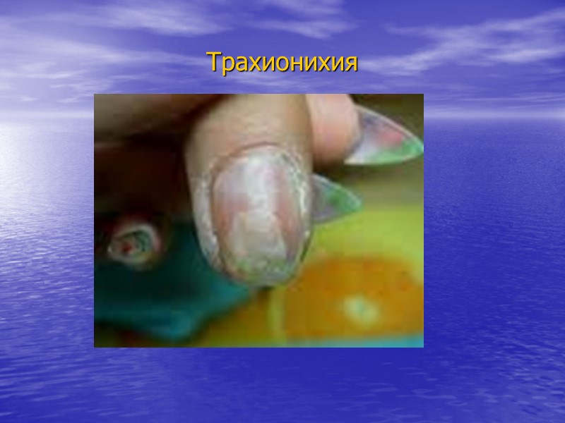 Изменения ногтевых пластинок при наследственных дерматозах Онихолизис — это частичное отделение ногтевой пластинки от