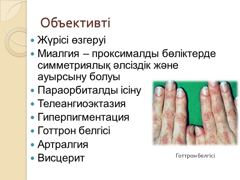 Объективті Жүрісі өзгеруі Миалгия – проксималды бөліктерде симметриялық әлсіздік және ауырсыну болуы Параорбиталды ісіну