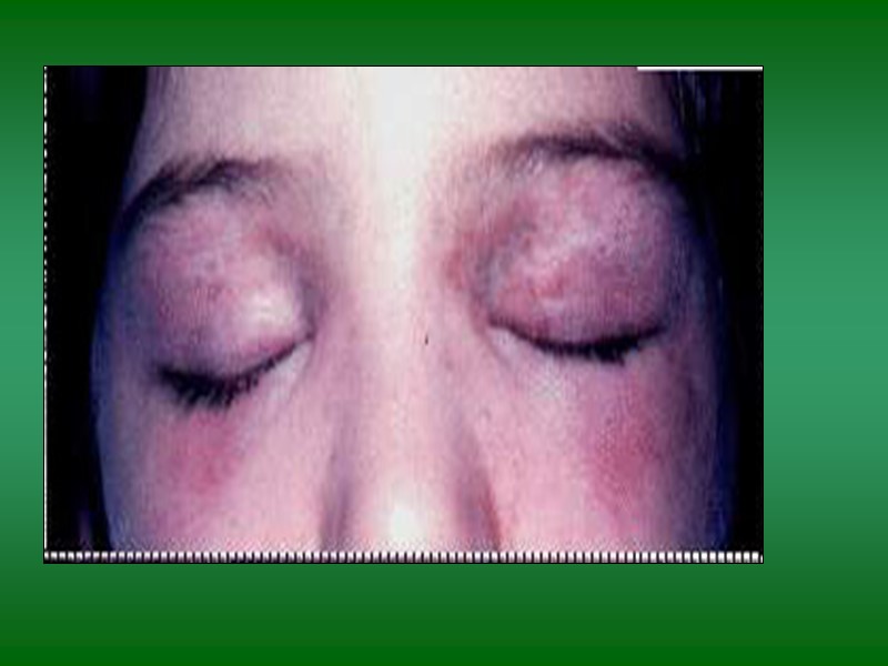 хроническое воспалительное заболевание  с преимущественным поражением скелетной мускулатуры   Полимиозит – 