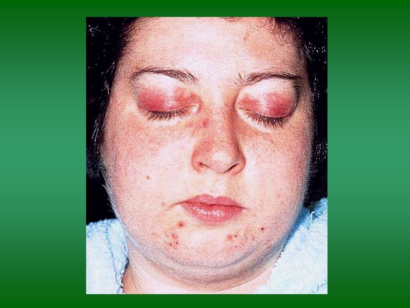 Классификация Идиопатический ДМ/ПМ ПМ/ДМ в сочетании со злокачественной опухолью (20-30%) Вторичный ДМ/ПМ (инфекция –