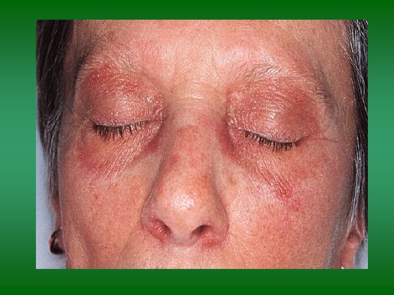 Сочетание ПМ/ДМ с опухолями Рак легких, желудка, яичника, молочных желез, поджелудочной железы, при ходжинской