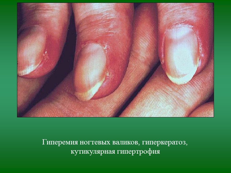 Эпидемиология  идиопатического ДМ/ПМ Заболеваемость составляет 2-10 случаев на 1 млн. населения Наблюдаются 2