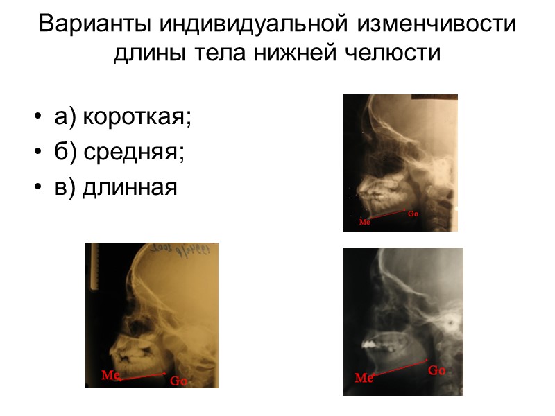 Телосложение и психические расстройства  Биполярное расстройство (маниакально-депрессивный, циркулярный психоз)  более вероятен у