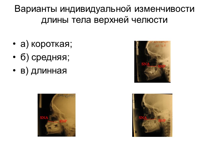 Телосложение и психические расстройства Неврозы  Неврастения и невроз навязчивых состояний – у астеников