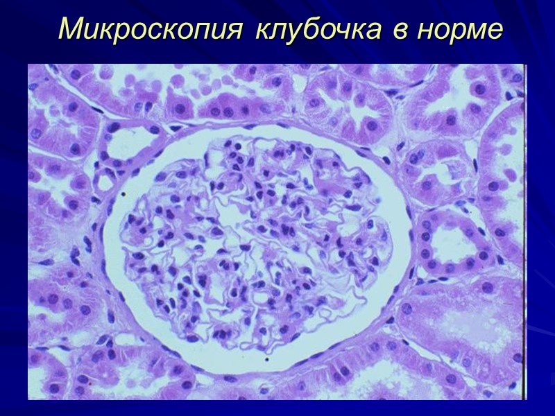 Непролифератинве гломерулонефриты  (поражается базальная мембрана, характерен нефротический синдром)  Мембранозная нефропатия Болезнь минимальных