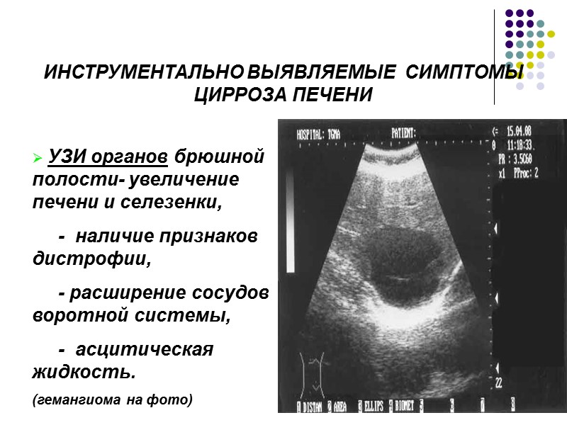 Цирроз Печени Узи Фото