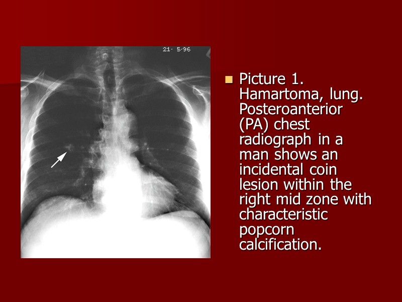 Hamartoma, lung. Posteroanterior (PA) chest radiograph shows an incidental finding of a solitary pulmonary