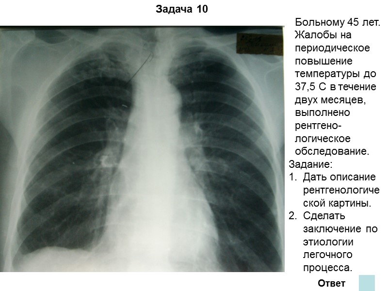 Задача 6 Ответ На обзорной рентгенограмме представлен синдром округлого образования. В верхней доле левого