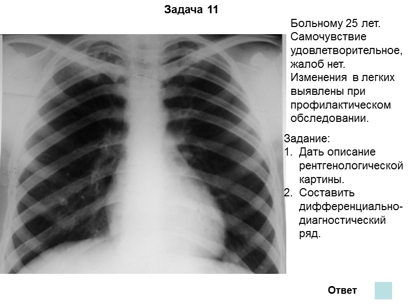 Задача 7 Ответ На обзорной рентгенограмме и томограмме верхушки левого легкого представлен синдром округлого
