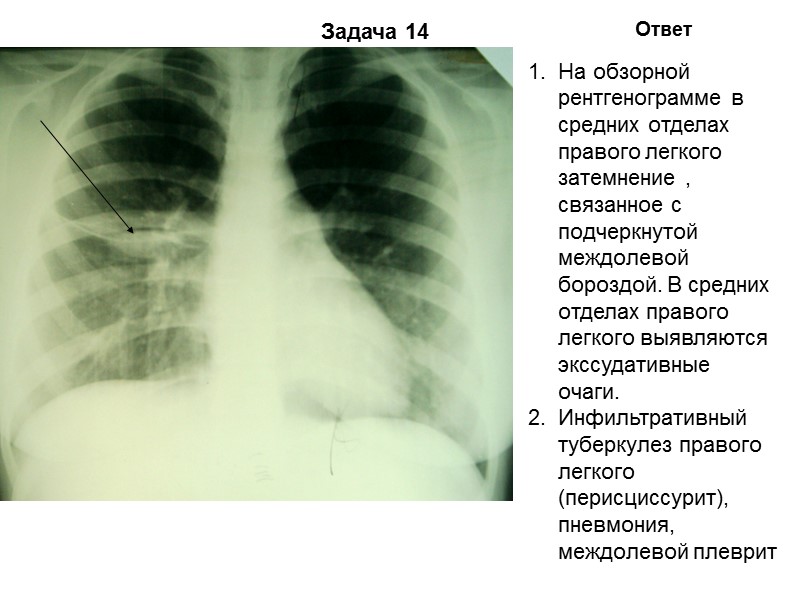 Задача 11 Ответ На обзорной рентгенограмме в 1, 2 сегменте правого легкого  