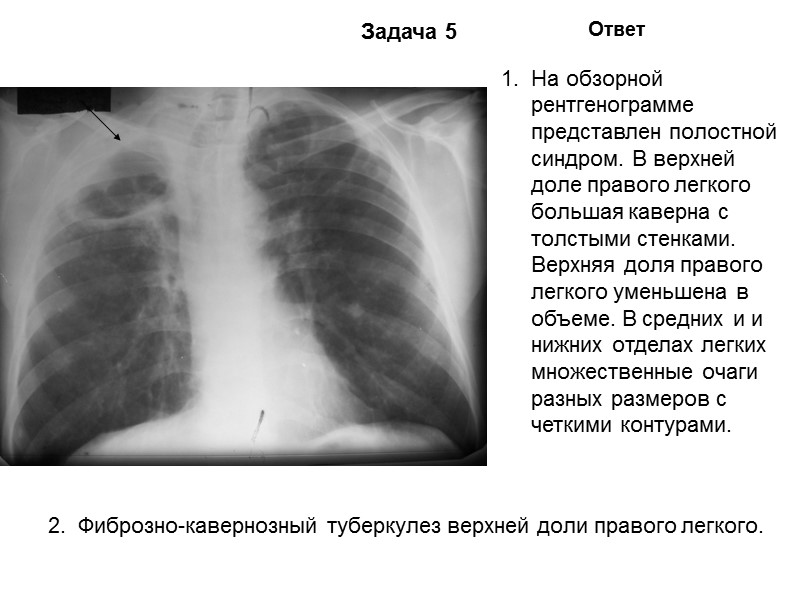 Задача 1 Ответ На обзорной рентгенограмме в 1-2 сегменте (верхней доле) левого легкого участок