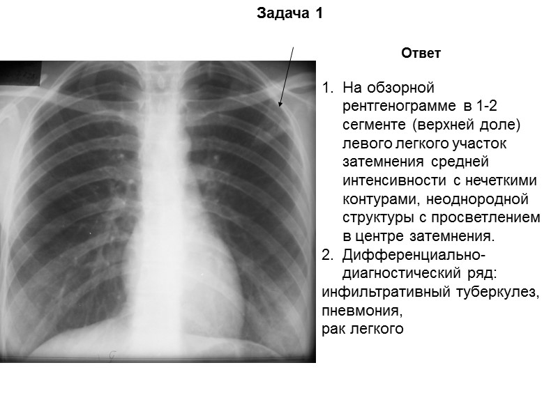 Задача 16 Ответ На обзорной рентгенограмме в верхних отделах обоих легких выявляется интенсивное, неоднородное