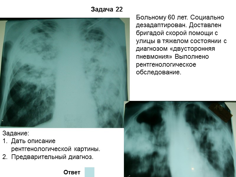 Задача 19 Ответ На обзорной рентгенограмме нижние отделы левого легкого интенсивно затемнены, синусы слева