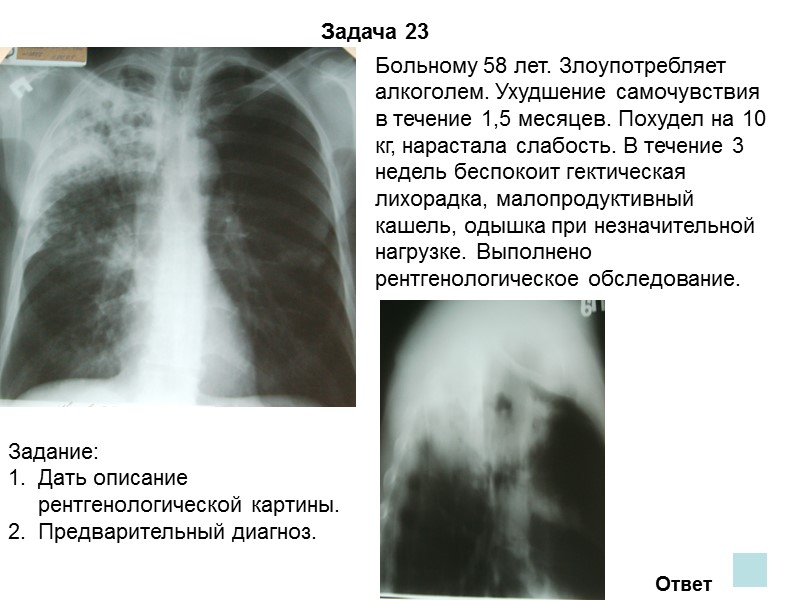 Задача 20 Ответ На обзорной рентгенограмме выявляется тотальное просветление слева, отсутствует легочный рисунок. Левое