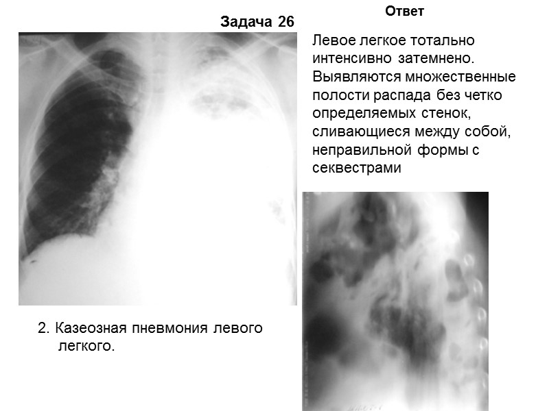Задача 24 Ответ 2. Предварительный диагноз: диссеминированный туберкулез легких. В обоих легких тотально симметрично