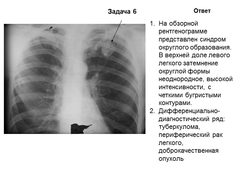 Задача 2 Ответ На обзорной рентгенограмме представлен синдром легочной диссеминации. Множественные очаги расположены тотально,