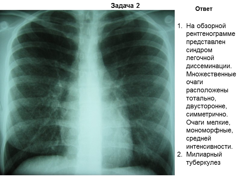Задача 27 Ответ Дифференциально-диагностический ряд: инфильтративный туберкулез нижней доли левого легкого в фазе распада,