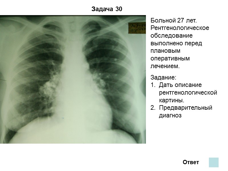 Задача 28 Ответ Предварительный диагноз: осумкованный плеврит слева туберкулезной этиологии. В нижних отделах левого