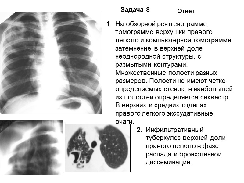 Задача 4 Ответ На обзорной рентгенограмме представлен синдром затемнения в верхней доле правого легкого.