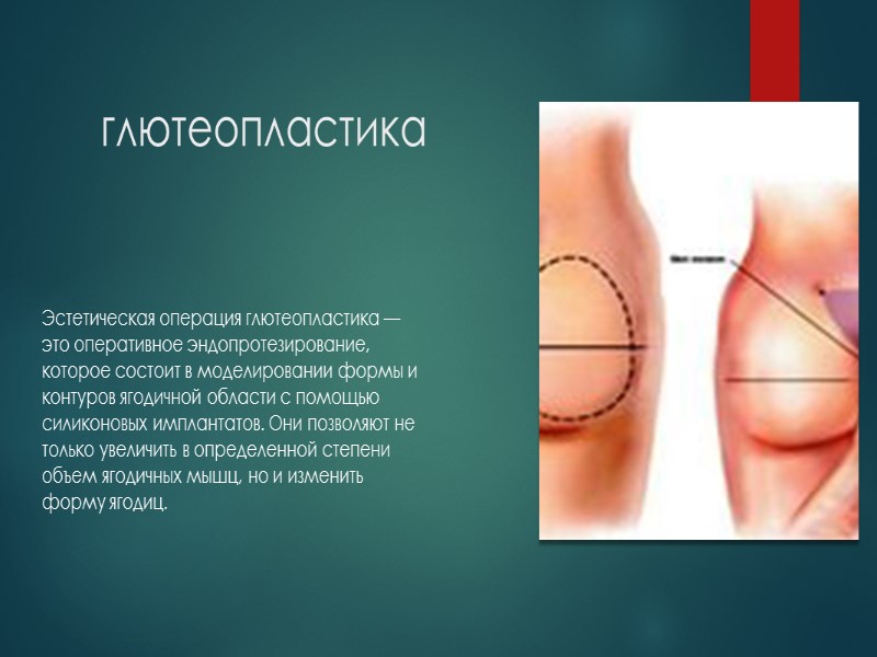 Рожки Популярная среди определенной части молодежи операция по вживлению под кожу головы рожек из