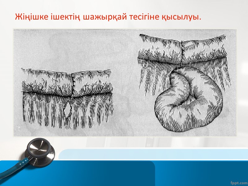 Жедел панкреатит Аурудың пайда болуы – біртіндеп; Аурудың орналасуы -  эпигастрий аймағында,оң және