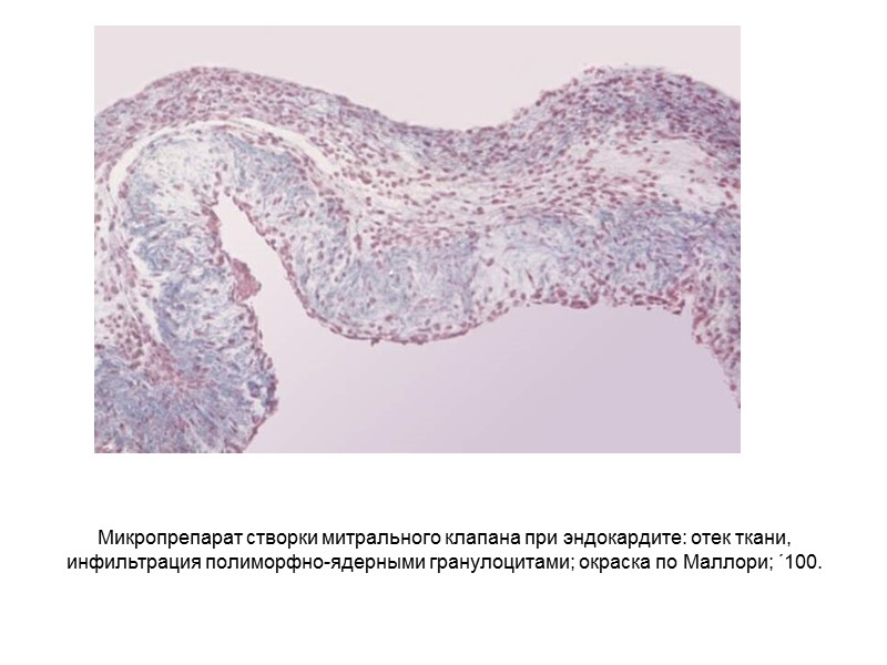 КТ органов грудной клетки и брюшной полости: с учетом клинико-лабораторных изменений КТ-картина может соответствовать