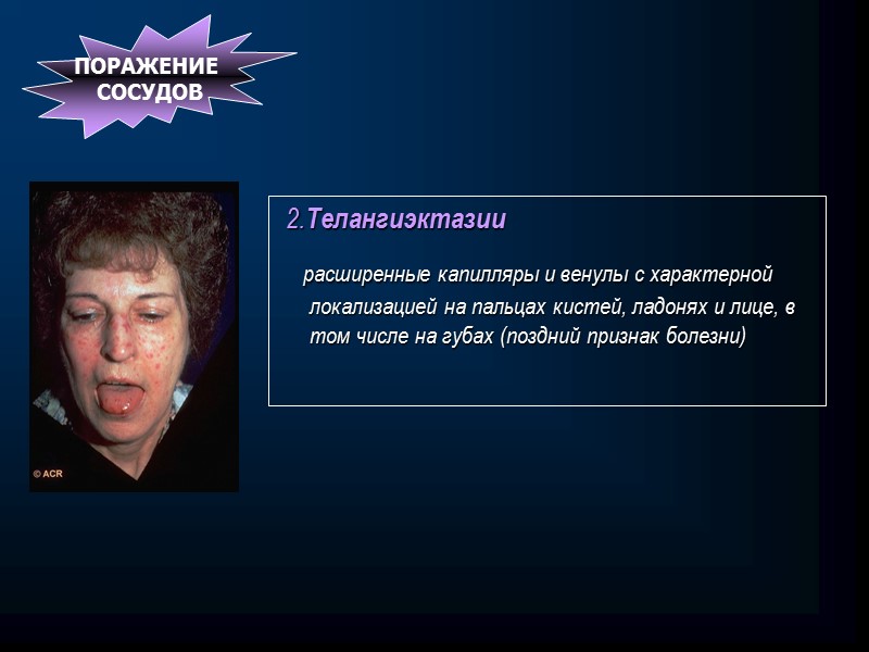 Псевдосклеродермия — изменения кожи, наблюдаемые при врождённых или приобретенных нарушениях метаболизма: (порфирия, фенилкетонурия, амилоидоз,