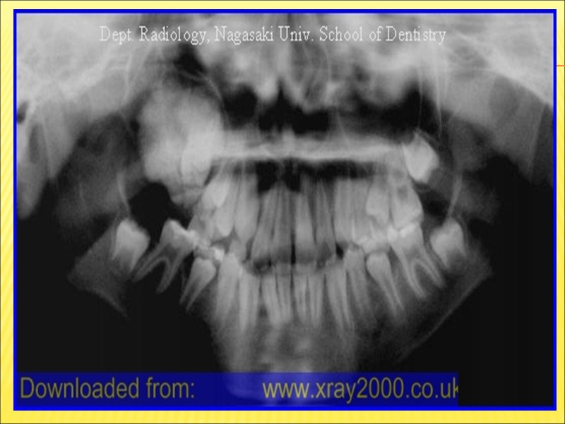 Одонтогенные опухоли -  опухоли, образование которых связано с пороком развития тканей,  из