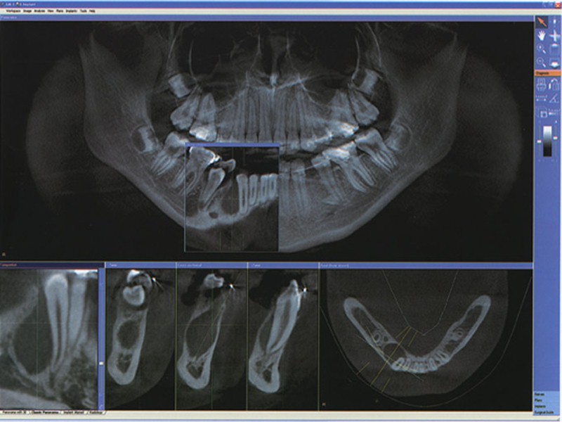 Техника операции:  1. Обезболивание  2. Рассечение тканей до кости разрезом на 0,5