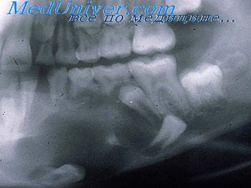 Пластическая цисэктомия     Показания:  ·     