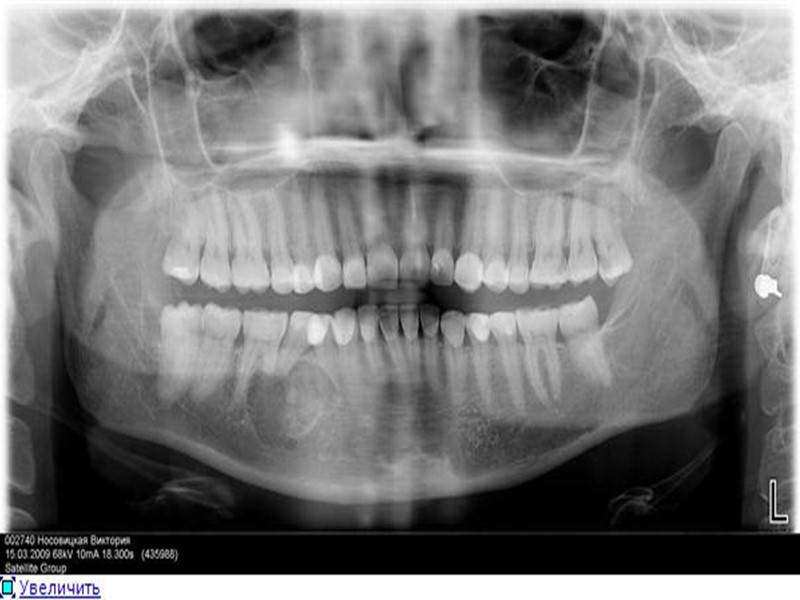 Ретромолярные (парадентальные) кисты: К ретромолярным кистам относятся такие кистозные «новообразования», которые локализуются обычно в