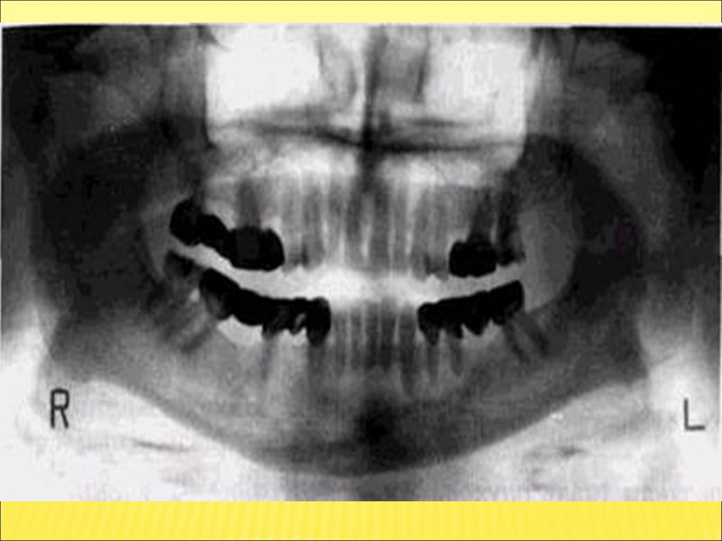 Лечение адамантином должно быть радикальным во избежание рецидивов, которые увеличивают угрозу малигнизации.  Методы